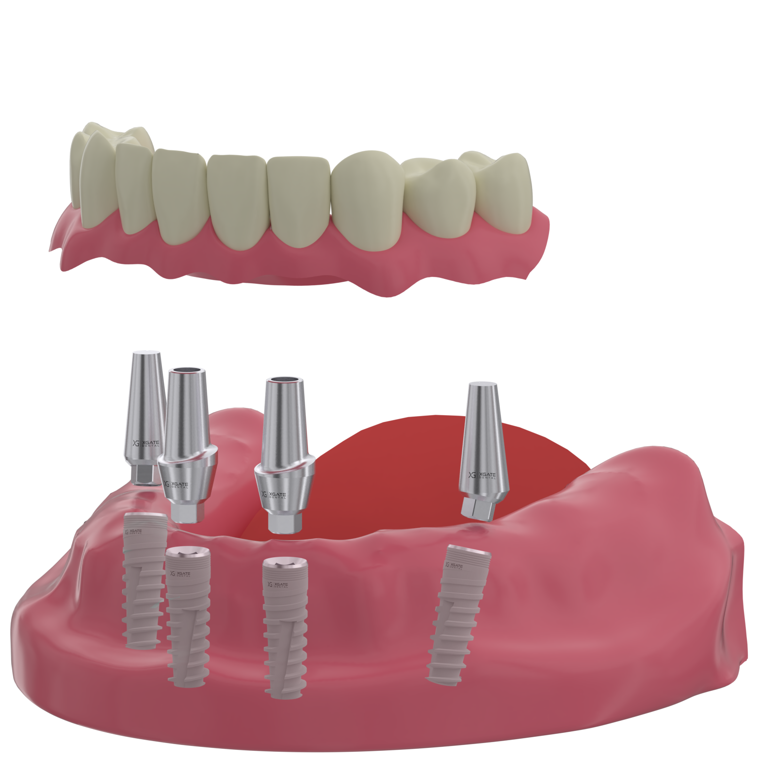 X-Gate İmplant 3.3mmDX8mmL